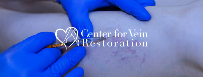 A doctor treats varicose veins with injection for a digital marketing agency’s SEO services page.